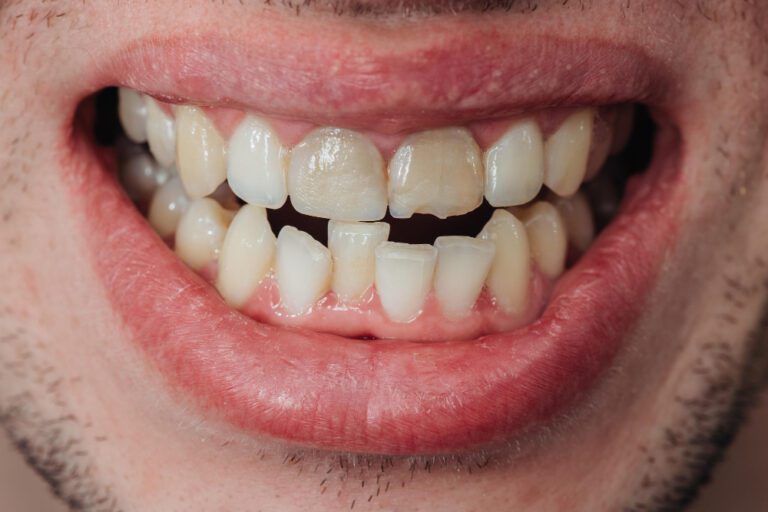 Ukruszony ząb – co zrobić?