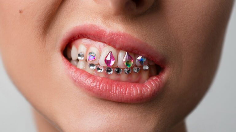 Biżuteria nazębna – wpływ na zdrowie zębów